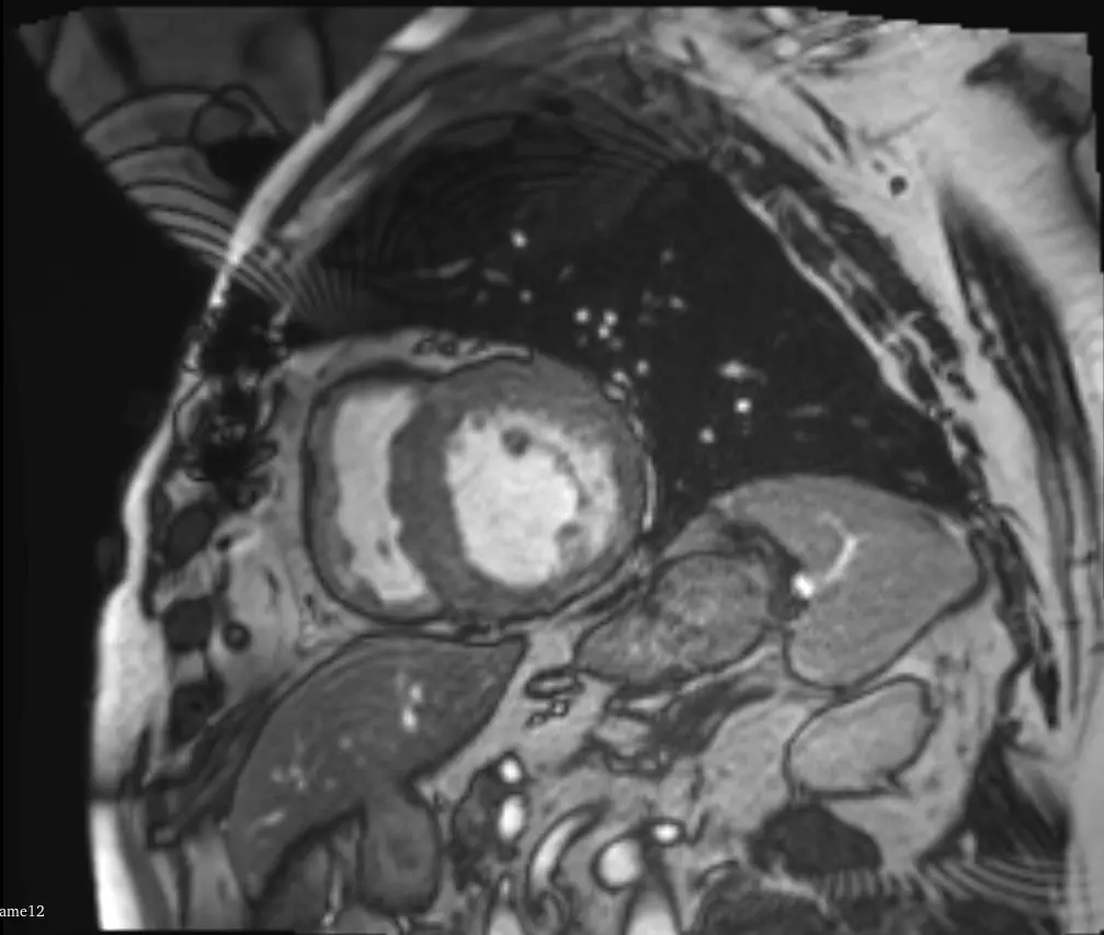 ACDC Cardiac MRI Segmentation